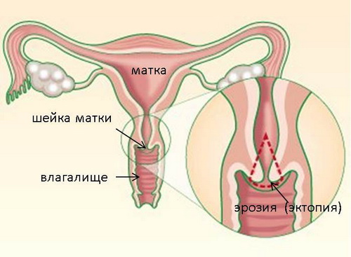 Симптомы эрозии шейки матки после родов