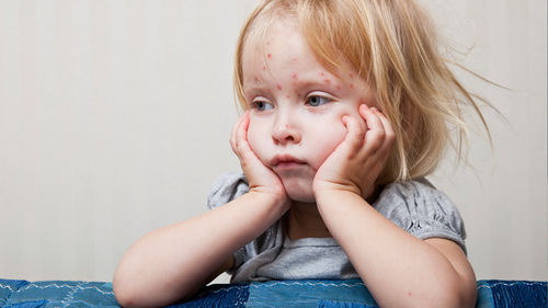 Когда делается прививка детям от оспы