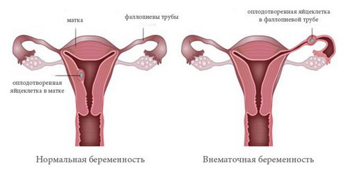 Внематочная беременность: симптомы
