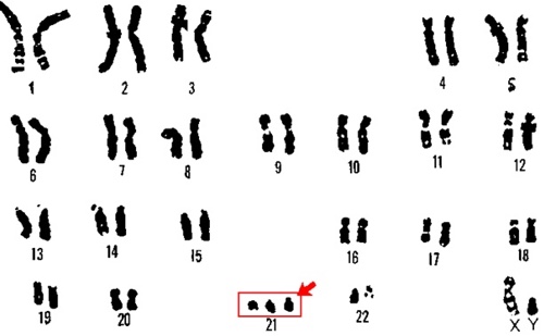 Анализ крови на хромосомные патологии ребенка