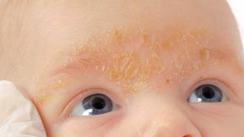 Себорейный дерматит у ребенка 3 года чем лечить thumbnail
