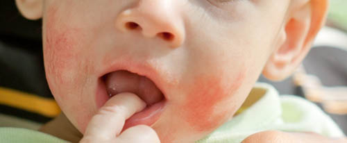 Как вы лечили себорейный дерматит у ребенка