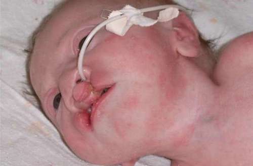 Синдром Патау у новорожденных