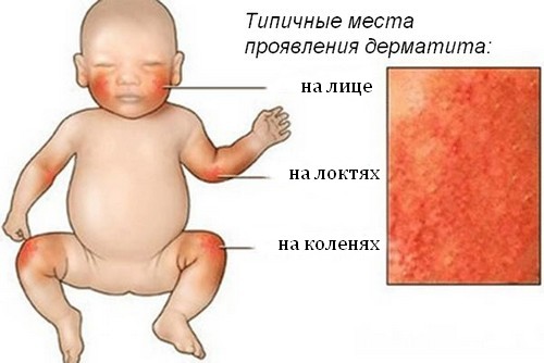 simptomy-allergicheskogo-dermatita