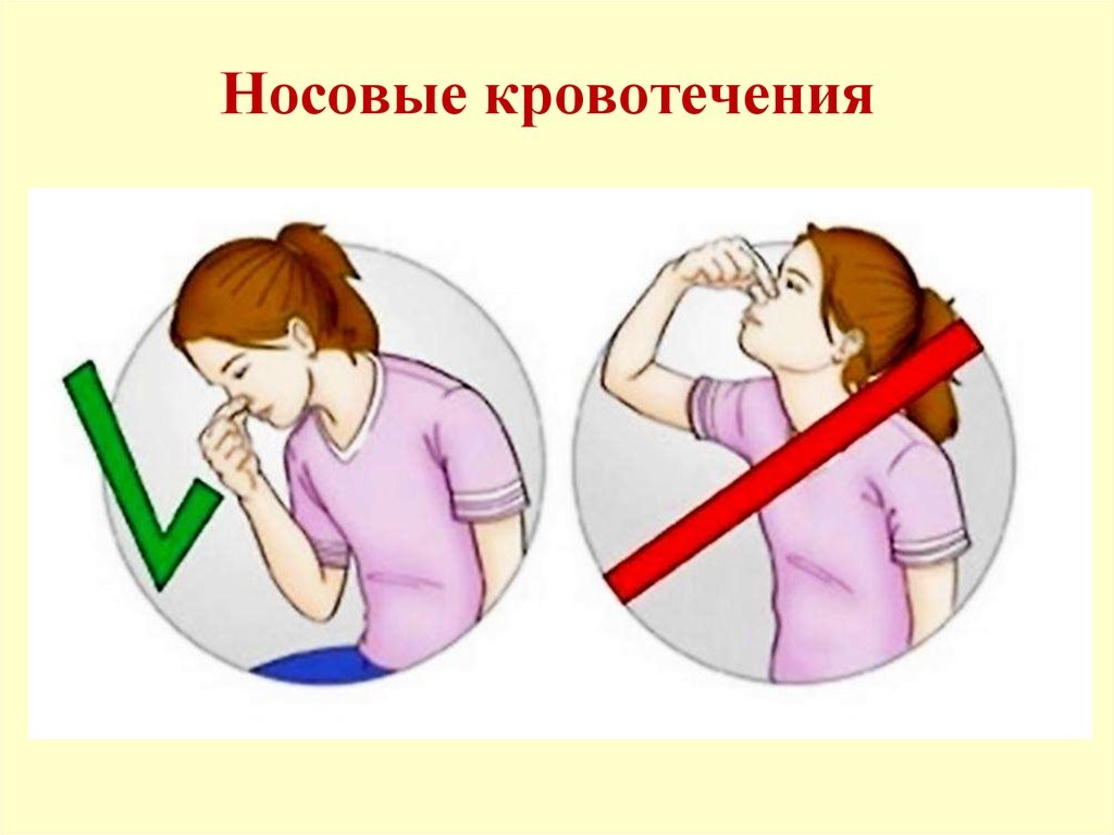 Остановить носовое кровотечение в домашних. Нососовое кровотечение. При кровотечении из носа. Носовое кровотечение первая помощь.