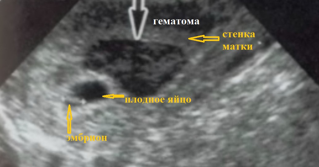 Гематома 1 триместр. Ретрохориальная гематома беременность. Ретрохориальная гематома на УЗИ. Преждевременная отслойка нормально расположенной плаценты УЗИ. Ретроамниотическая гематома ретрохориальная гематома.
