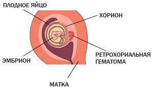 ретрохориальная гематома